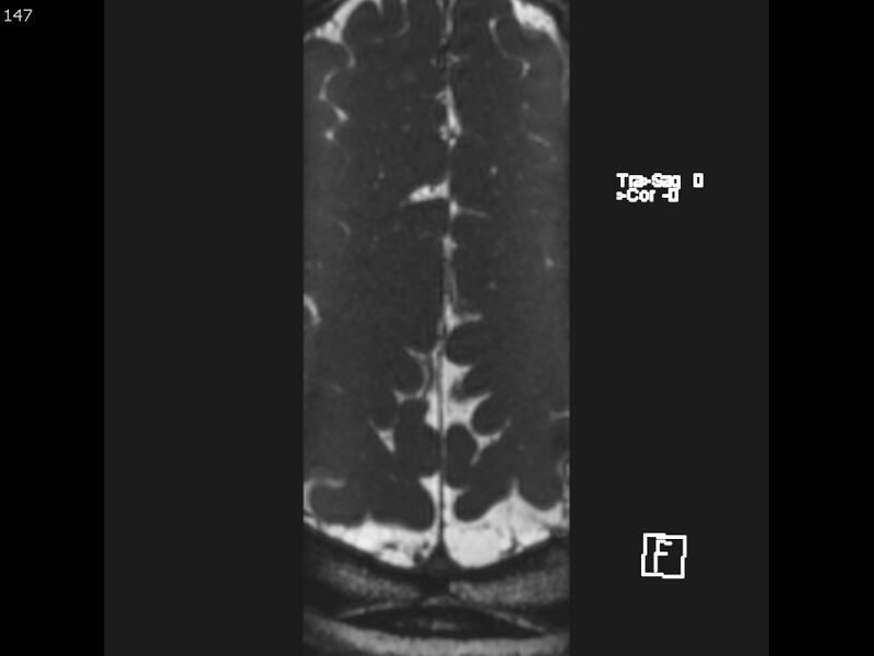 File:Atypical meningioma - intraosseous (Radiopaedia 64915-74572 Axial CISS 147).jpg
