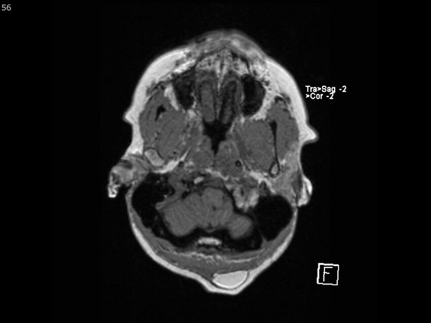 Atypical meningioma - intraosseous (Radiopaedia 64915-74572 Axial T1 56).jpg