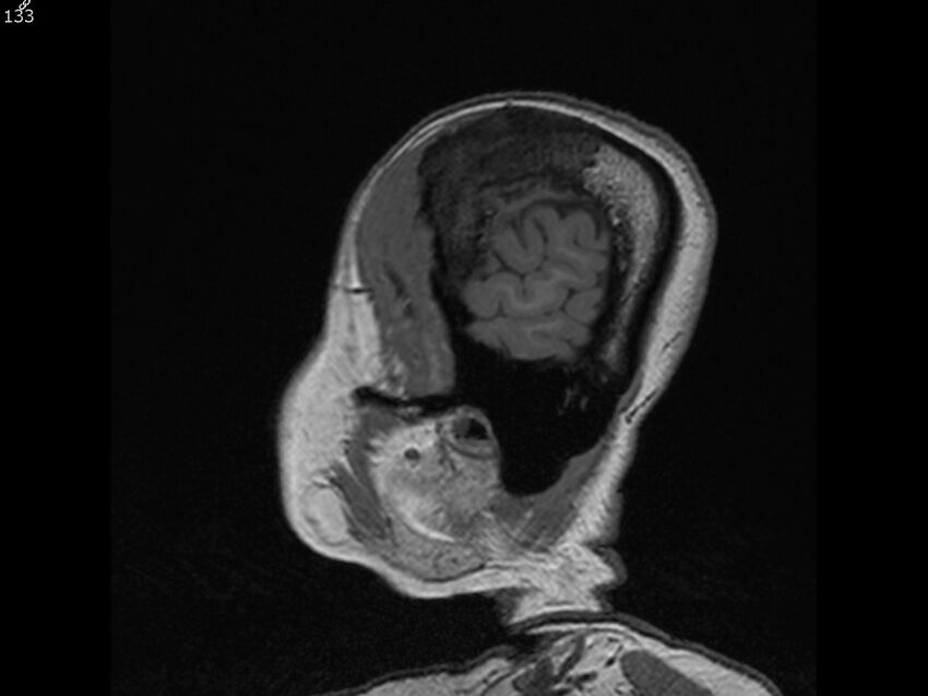 Atypical meningioma - intraosseous (Radiopaedia 64915-74572 Sagittal T1 133).jpg