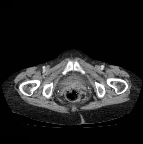 File:Autosomal dominant polycystic kidney disease (Radiopaedia 16777-16490 A 57).jpg