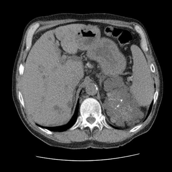 File:Autosomal dominant polycystic kidney disease (Radiopaedia 27851-28094 Axial non-contrast 55).jpg