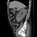Autosomal dominant polycystic kidney disease (Radiopaedia 36539-38101 D 27).jpg