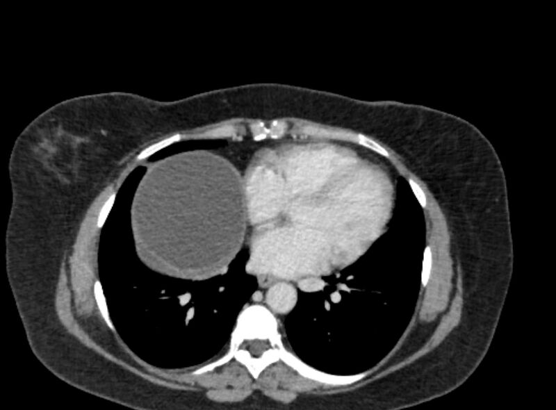 File:Autosomal dominant polycystic kidney disease (Radiopaedia 57124-64017 A 8).jpg