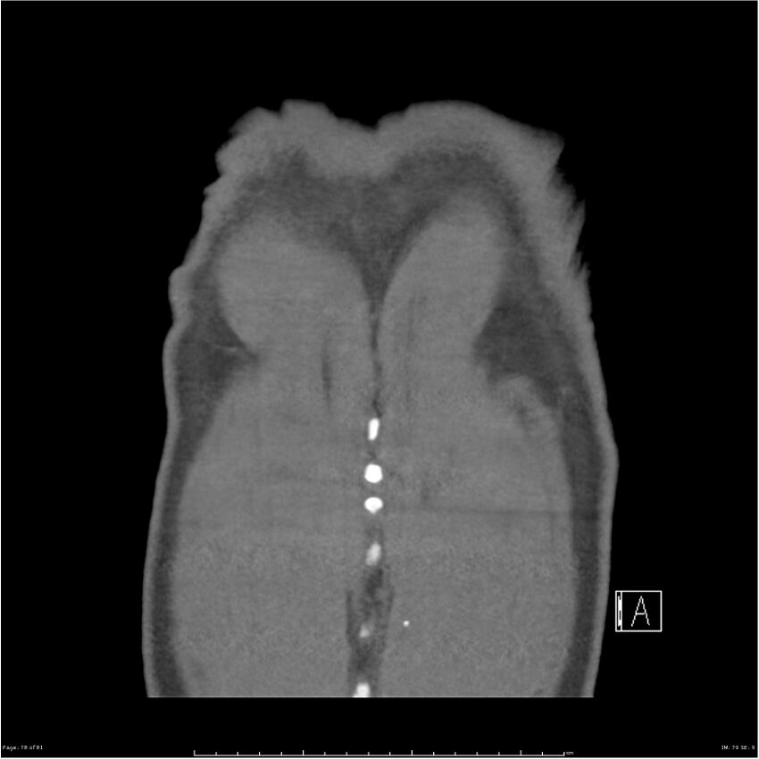 Azygos venous system anatomy (CT pulmonary angiography) (Radiopaedia 25928-26077 Coronal C+ CTPA 78).jpg