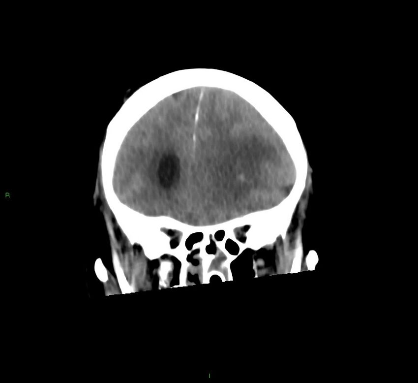 Basal ganglia hemorrhage (Radiopaedia 58775-66008 Coronal non-contrast 47).jpg
