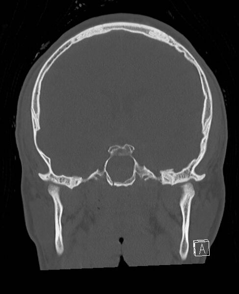 File:Base of skull fracture with bilateral Le Fort fractures (Radiopaedia 47094-51638 Coronal bone window 53).jpg