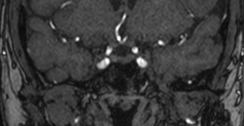 Basilar artery fenestration (Radiopaedia 74537-85455 Coronal MRA TOF 1).jpg