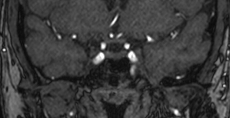 File:Basilar artery fenestration (Radiopaedia 74537-85455 Coronal MRA TOF 4).jpg