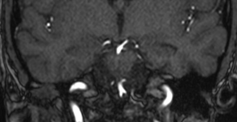 File:Basilar artery fenestration (Radiopaedia 74537-85455 Coronal MRA TOF 43).jpg