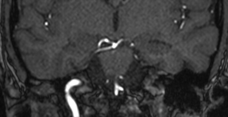 File:Basilar artery fenestration (Radiopaedia 74537-85455 Coronal MRA TOF 46).jpg