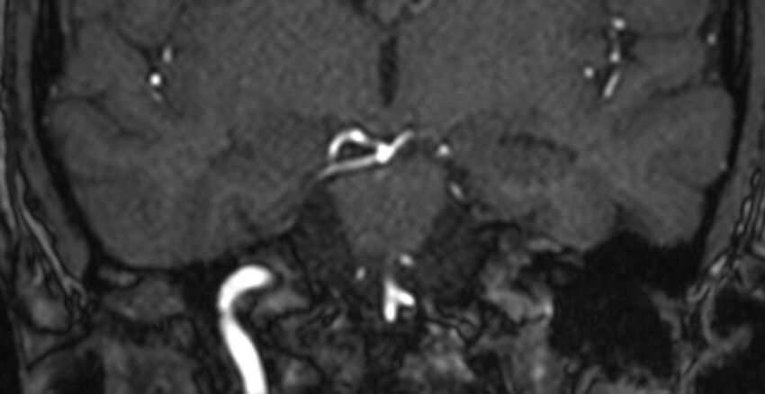 Basilar artery fenestration (Radiopaedia 74537-85455 Coronal MRA TOF 46).jpg