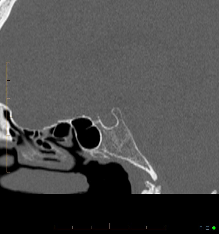 Benign notochordal cell tumor (probable) (Radiopaedia 65475-74546 Sagittal bone window 17).jpg