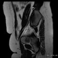 Bicornuate uterus- on MRI (Radiopaedia 49206-54297 Sagittal T2 25).jpg