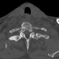 Bilateral C6-7 locked facet dislocation (Radiopaedia 28506-28748 Axial bone window 34).jpeg