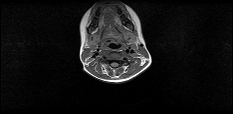File:Bilateral Sprengel deformity with Klippel-Feil syndrome (Radiopaedia 66395-75650 Axial T1 10).jpg