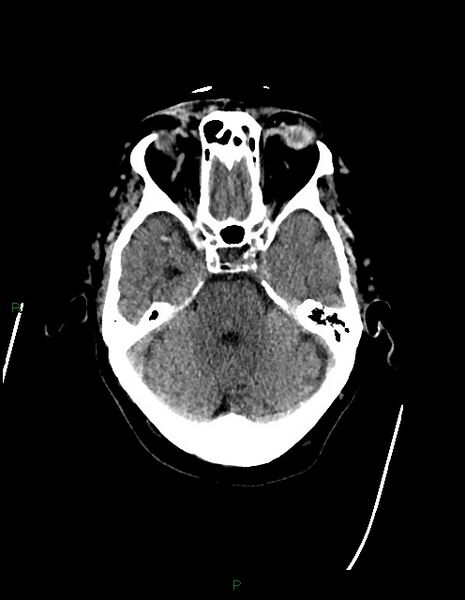 File:Bilateral acute middle cerebral artery territory infarcts (Radiopaedia 77319-89401 Axial non-contrast 26).jpg