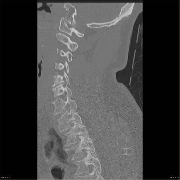 File:Bilateral cervical ribs (Radiopaedia 25868-26017 Sagittal bone window 45).jpg