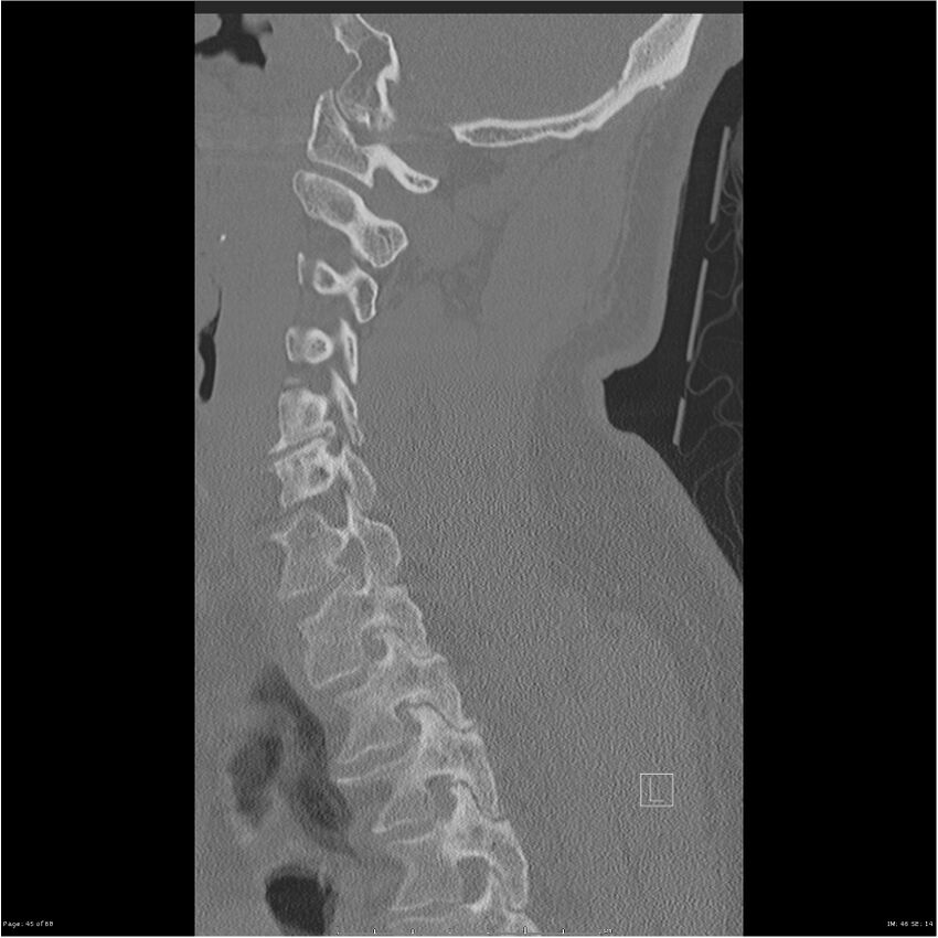Bilateral cervical ribs (Radiopaedia 25868-26017 Sagittal bone window 45).jpg