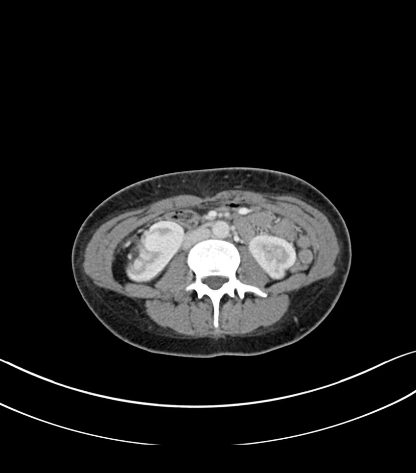 Bilateral kidney malrotation (Radiopaedia 72227-82749 A 31).jpg