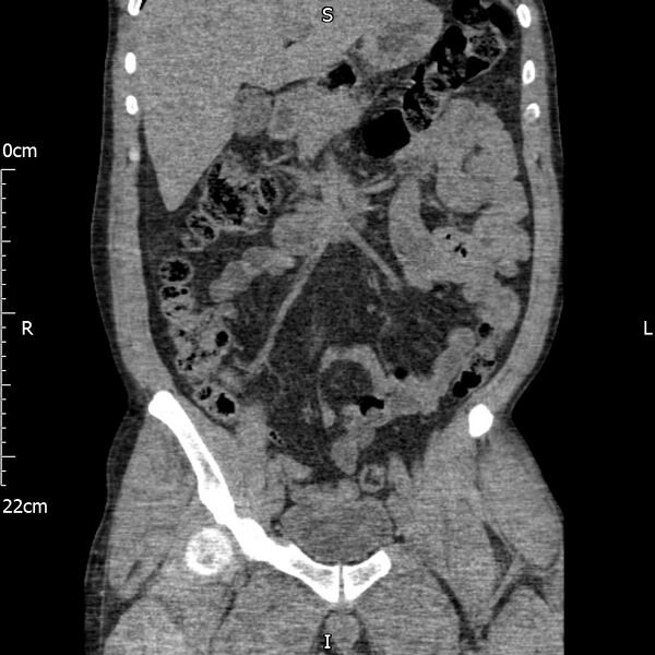 File:Bilateral medullary nephrocalcinosis with ureteric calculi (Radiopaedia 71269-81569 Coronal non-contrast 26).jpg