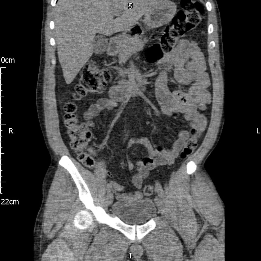 Bilateral medullary nephrocalcinosis with ureteric calculi (Radiopaedia 71269-81569 Coronal non-contrast 26).jpg