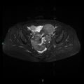 Bilateral ovarian fibroma (Radiopaedia 44568-48293 Axial STIR 14).jpg
