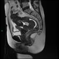 Bilateral ovarian fibroma (Radiopaedia 44568-48293 Sagittal T2 17).jpg