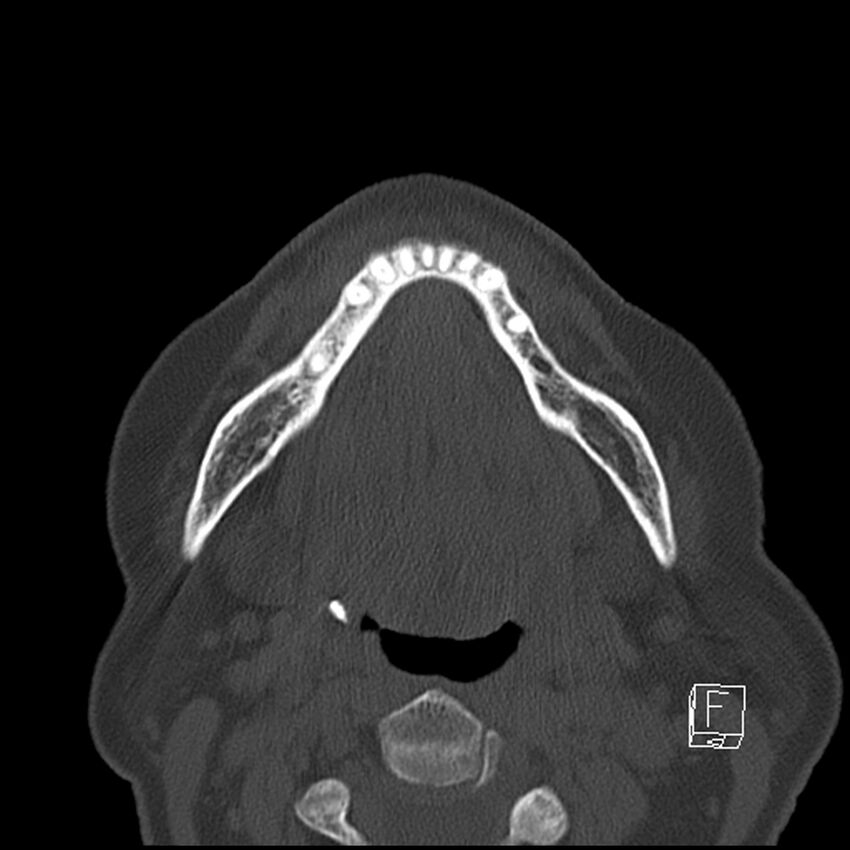 Bilateral palatine tonsilloliths on OPG and CT (Radiopaedia 75167-86247 Axial bone window 48).jpg