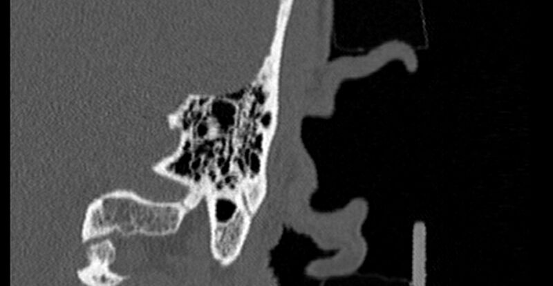 File:Bilateral temporal bone fractures (Radiopaedia 29482-29970 B 80).jpg