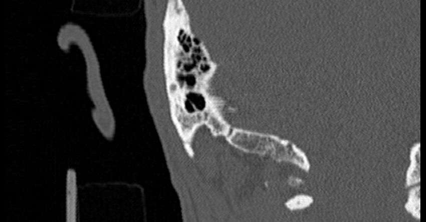 Bilateral temporal bone fractures (Radiopaedia 29482-29970 Coronal non-contrast 169).jpg