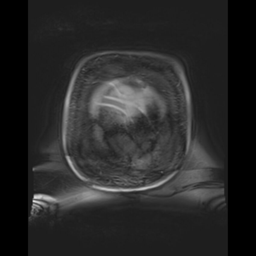 Bilobed placenta accreta (Radiopaedia 69648-79591 Coronal T1 vibe 10).jpg