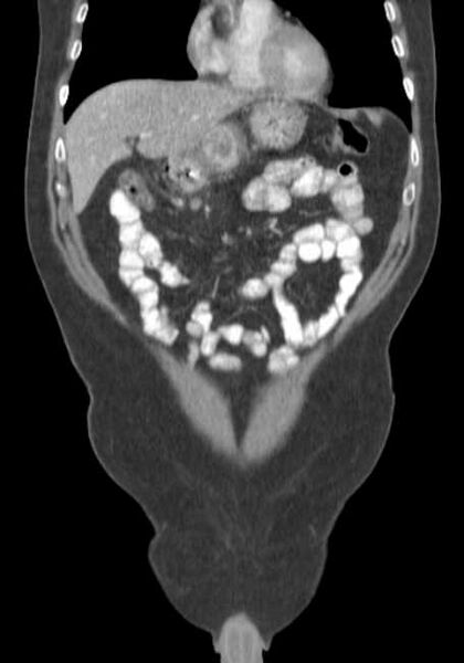 File:Bleeding duodenal ulcer and adenomyomatosis of gallbladder (Radiopaedia 61834-69861 B 65).jpg