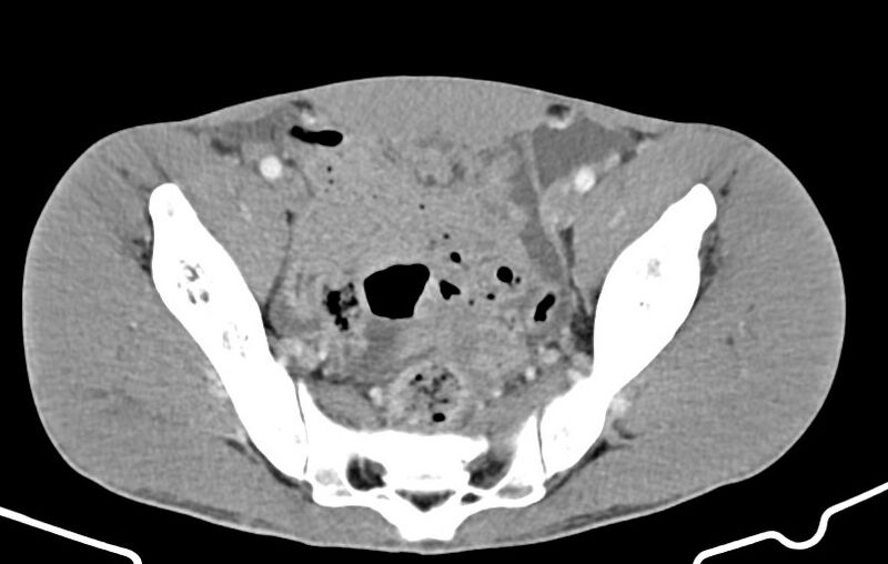 File:Blunt injury to the small bowel (Radiopaedia 74953-85987 A 163).jpg