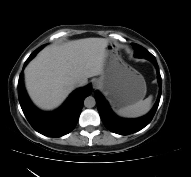 File:Bosniak renal cyst - type IV (Radiopaedia 22929-22953 Axial non-contrast 6).jpg
