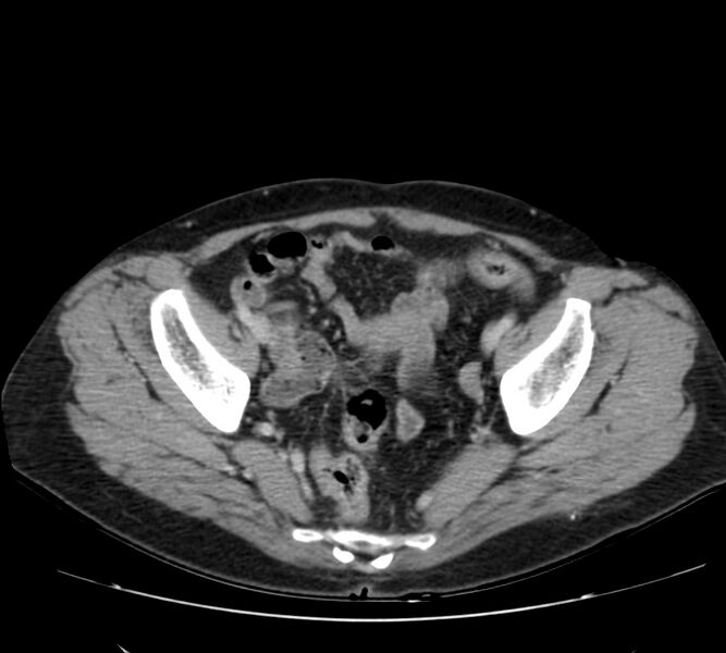 File:Bosniak renal cyst - type IV (Radiopaedia 22929-22953 C 57).jpg