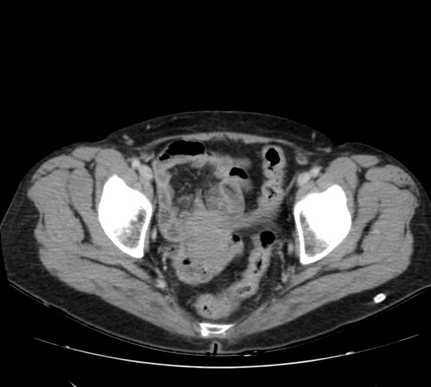 Bosniak renal cyst - type IV (Radiopaedia 22929-22953 C 61).jpg
