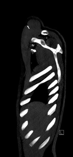 File:Brachiocephalic trunk pseudoaneurysm (Radiopaedia 70978-81191 C 9).jpg