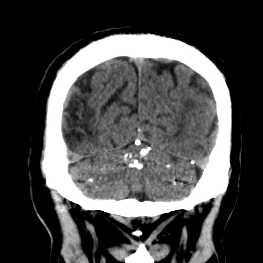 Brain Pantopaque remnants (Radiopaedia 78403-91048 Coronal non-contrast 57).jpg