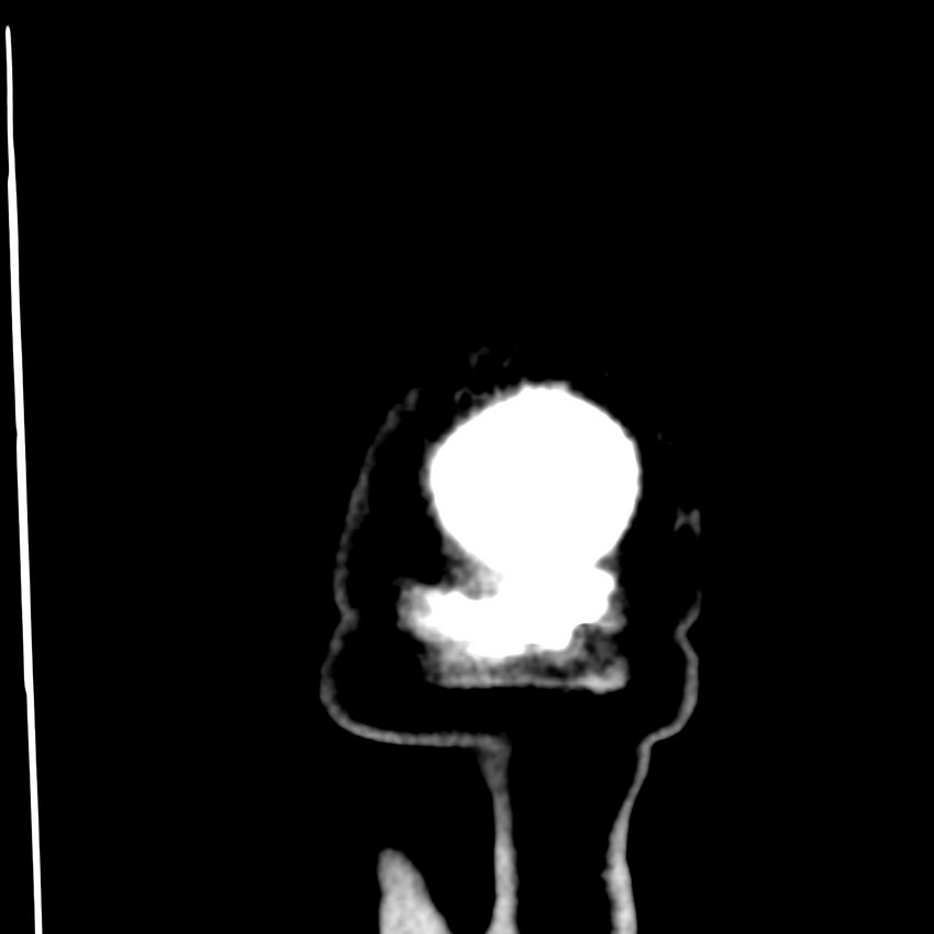 Brain Pantopaque remnants (Radiopaedia 78403-91048 Coronal non-contrast 74).jpg