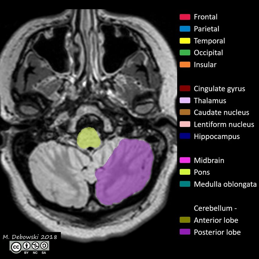 Brain lobes - annotated MRI (Radiopaedia 61691-69700 Axial 66).JPG