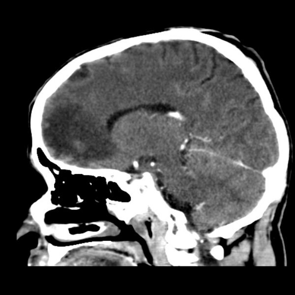 File:Brain metastases from lung cancer (Radiopaedia 24480-24781 C+ delayed 34).jpg