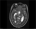 Brainstem glioma (Radiopaedia 21819-21775 Axial T2 17).jpg