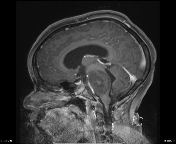 File:Brainstem glioma (Radiopaedia 21819-21775 D 20).jpg