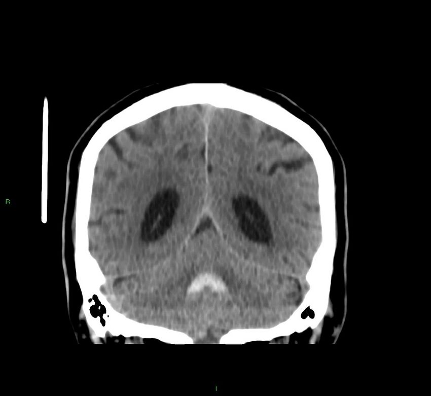 Brainstem hemorrhage (Radiopaedia 58794-66028 Coronal non-contrast 22).jpg