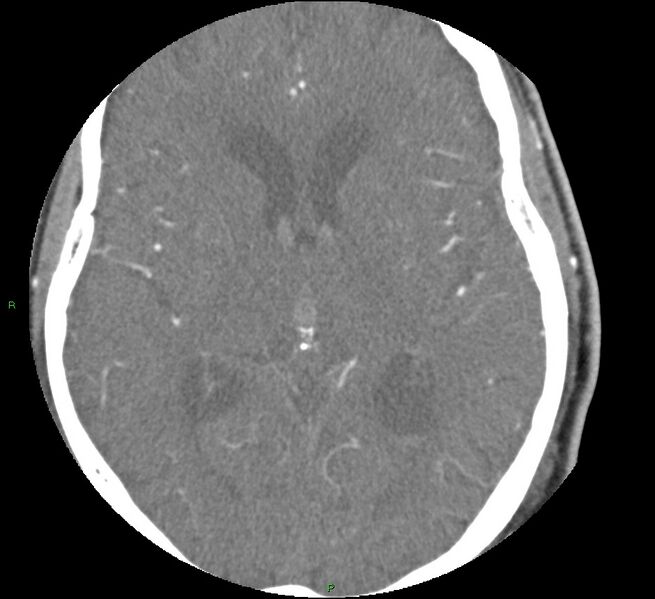 File:Brainstem hemorrhage (Radiopaedia 58794-66028 D 99).jpg