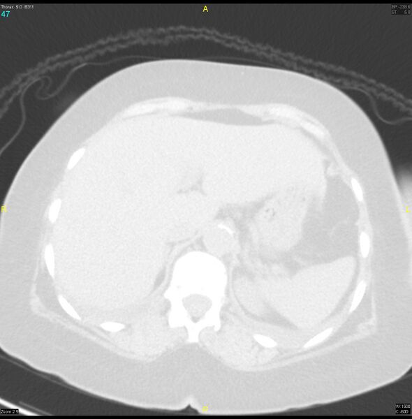 File:Breast primary with lung and bone metastases (Radiopaedia 40620-43228 Axial lung window 47).jpg