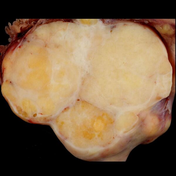 File:Brenner tumor of ovary (gross pathology) (Radiopaedia 9587).jpg