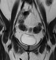 Broad ligament leiomyoma (Radiopaedia 81634-95516 Coronal T2 5).jpg