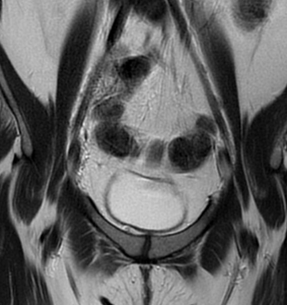 File:Broad ligament leiomyoma (Radiopaedia 81634-95516 Coronal T2 5).jpg