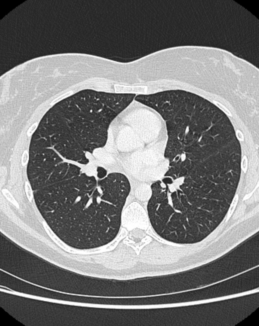 Bronchial atresia (Radiopaedia 50007-55297 Axial lung window 52).jpg